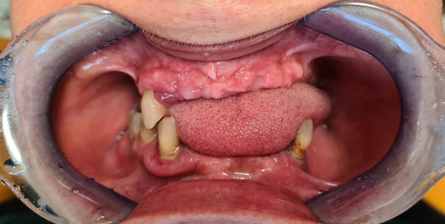 Fig. 1_Caso iniziale senza protesi.