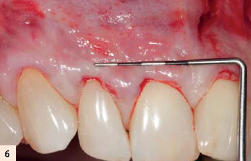 Incision et relâchement du lambeau. Incision vestibulaire pour accès sous périostée (incision muqueuse horizontale) permet une dissection horizontale de pleine épaisseur. Le relâchement total du lambeau permet au clinicien d’éviter une pression incontrôlée du lambeau sur les membranes A-PRF et permet le positionnement coronaire complet et passif des tissus mous