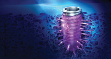 Osseointegration of the future with Osstem’s TSIII SOI implant