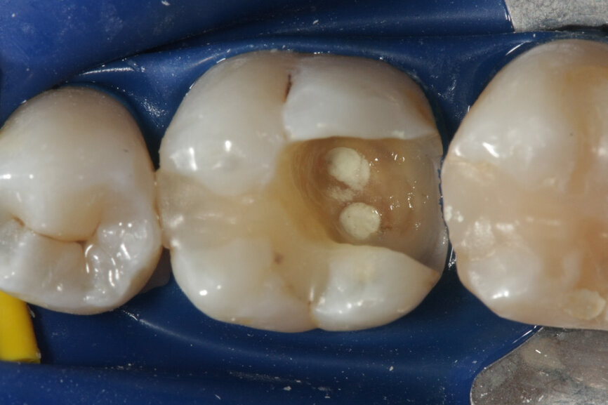 Fig. 1c: (a) Deep carious lesion. (b) Partial pulpotomy. (c) MTA application with the MAP System and PD MTA White. (d) Filling. (e) Post-op radiograph showing the pulp capping with MTA.