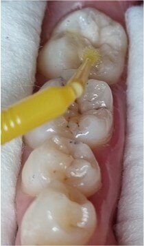 Fig. 7: EQUIA Forte Coat was applied and light-polymerised.