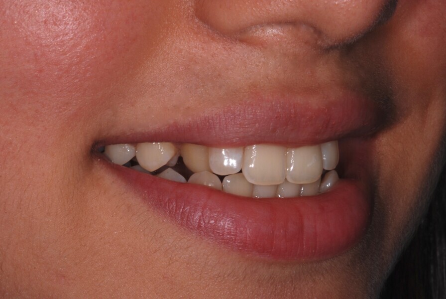 Fig. 7: Smile right side view before treatment.