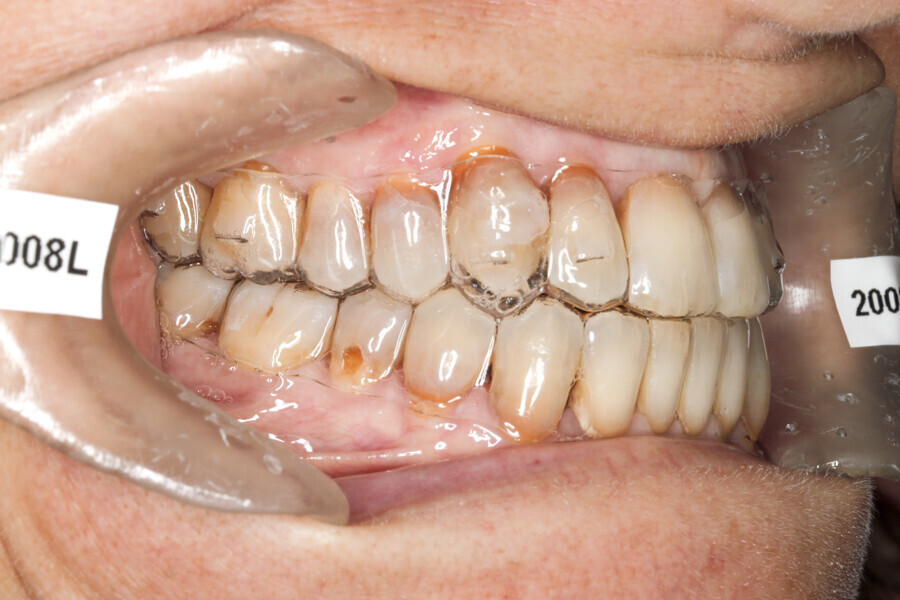 Fig. 43: Final stage of Reveal aligners. Aligner #37.