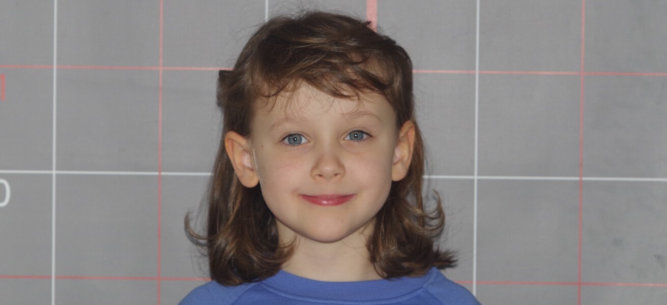 Fig. 12a: Initial facial photograph: frontal facial view showing asymmetry of the eyes and auricular exposure.