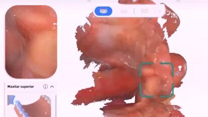 Labio y paladar fisurado Jesus video4