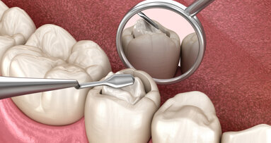 Einigung zwischen ÖZÄK und KFA Wien über Amalgamersatz und Pilotprojekt zur Mundhygiene