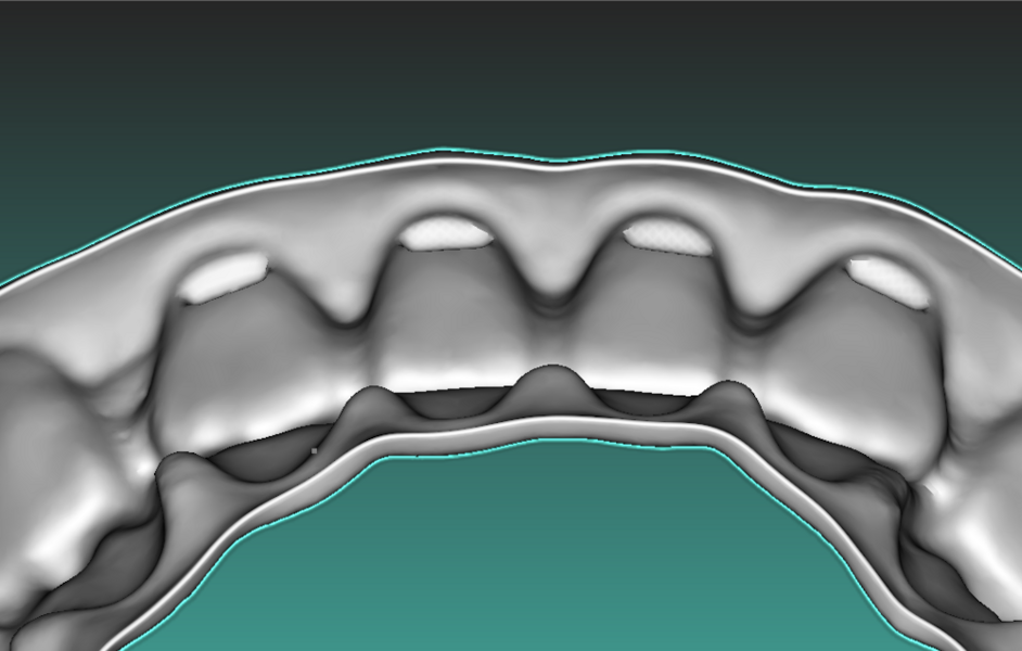 Fig. 10a: Pressure points at the cervical third of the labial inner surface of the aligner.