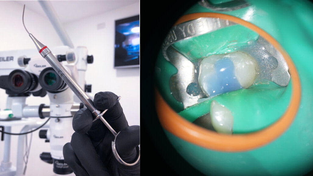 Unmittelbare Pulpa-Überkappung als konservatives Verfahren zum Erhalt der Pulpenvitalität