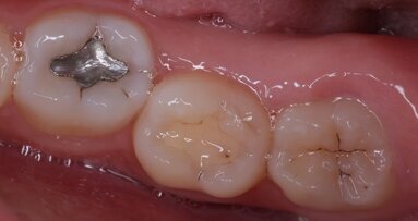 Dental amalgam reduction endorsed by EU enters into effect