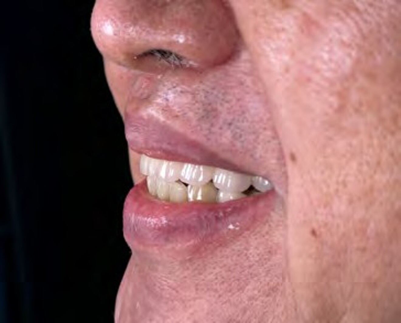  Fig. 3l: Left oblique smile view demonstrating facial profile support and smile aesthetics after  rehabilitation. 