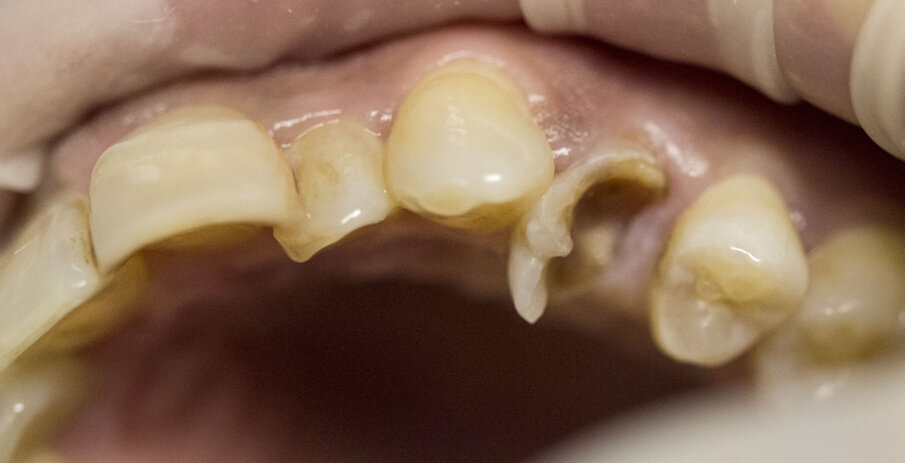 Fig. 3 - Dente fratturato 2.4.