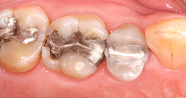 US dentists are using nearly half of country’s total mercury in products