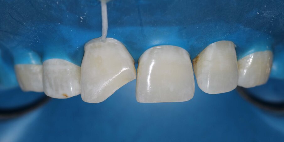 Fig 6: Isolation with Rubber Dam and Floss Tie