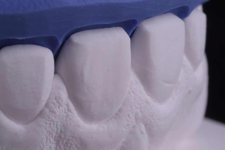 Fig. 37: Sectioned silicone key on the plaster model for laboratory
reduction.