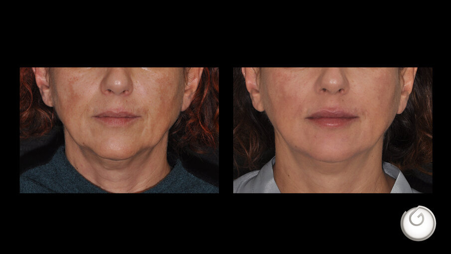 Prima e dopo il trattamento