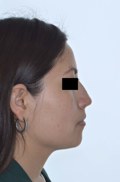 Fig. 9a: Final profile and smile.