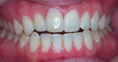 Immediate implantation and provisionalization: Single-tooth restoration in the esthetic zone