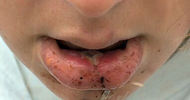 Dentists, Pharmacists Raise Awareness of Medication-Induced Dry Mouth