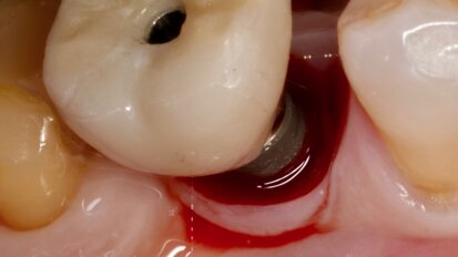 Interacción entre factores protésicos y sistémicos en la periimplantitis 