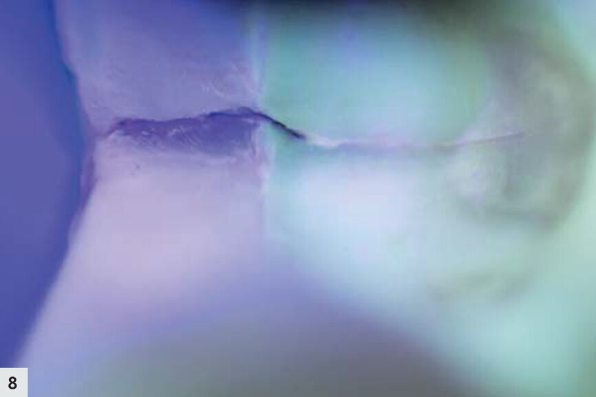 Fig. 8 : La fluorescence est sensible aux modifications structurales. La couleur violet foncée indique la partie la plus profonde de la fissure. La dentine peut être clairement délimitée grâce à la fluorescence légèrement verte. 