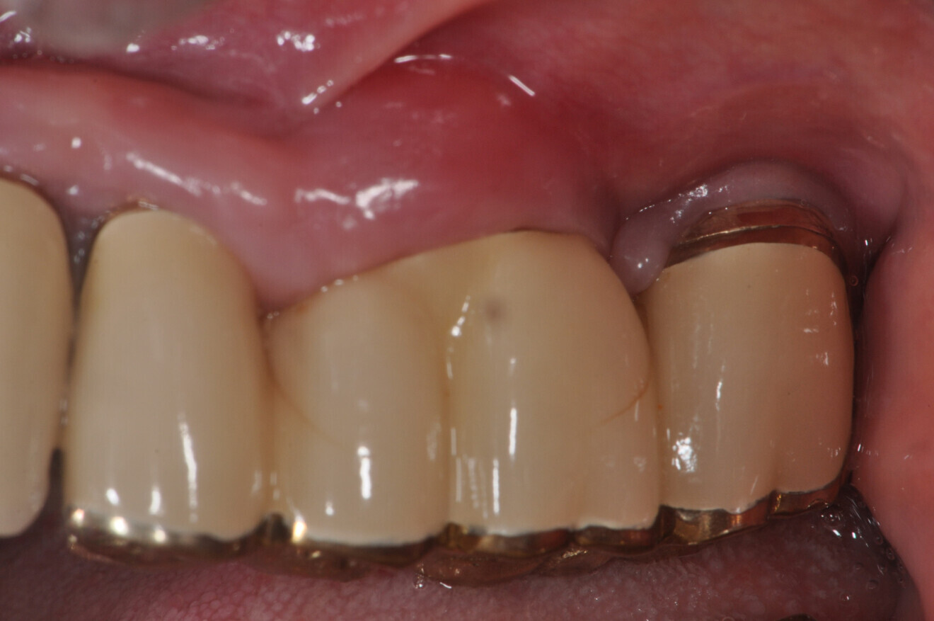 The state of peri-implantitis during a maintenance visit.