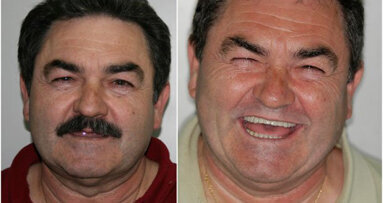 Planificación y colocación de implantes con CAD/CAM