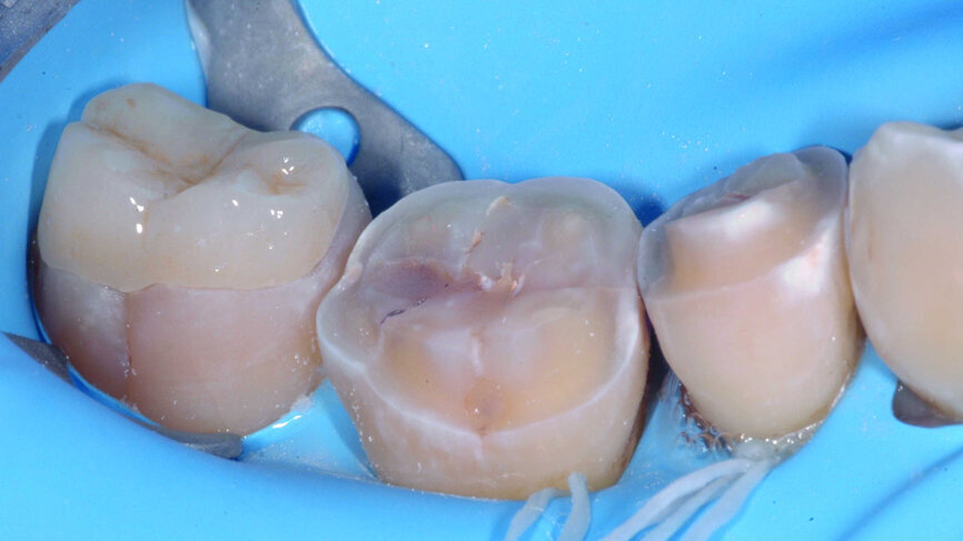 Fig. 9 : Essayage sous digue Nic Tone Heavy.