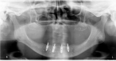 Analiza porównawcza występowania periimplantitis – kliniczne obserwacje 4-letnie