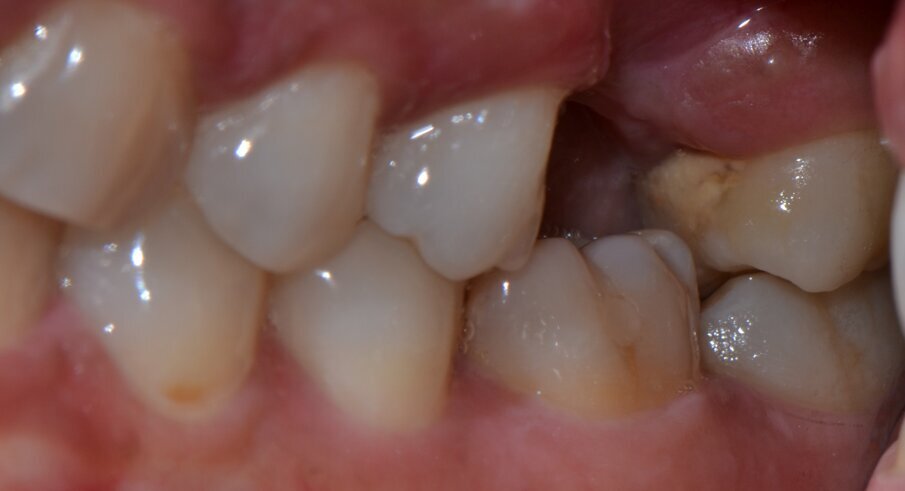 Fig 6: supraerupted 36