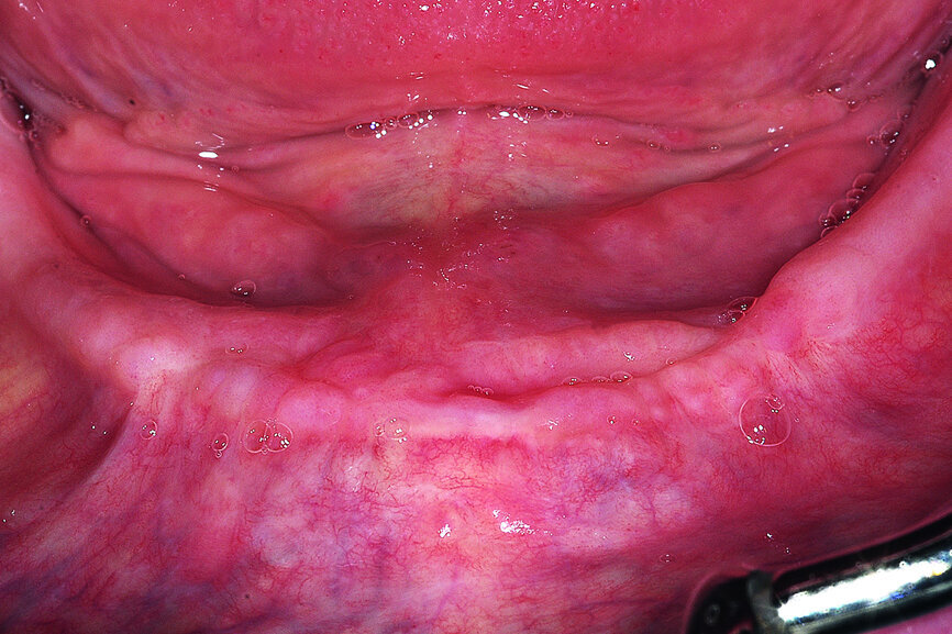 Fig. 19a: Healed site at three months (a). Uncovering of the integrated implants, healing collars and SmartPeg to measure ISQ values postoperatively (b). SmartPeg measuring ISQ values at uncovering (c).