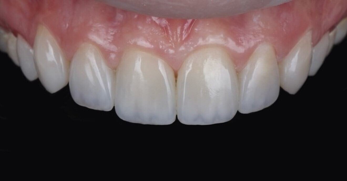 Fig. 2d: Intra-oral view of anterior teeth after  direct veneer restoration.