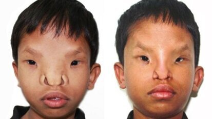 Момче възстанови зрението си след операция на лицето