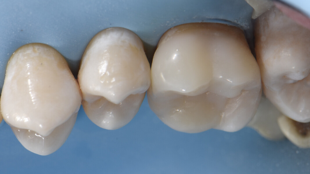Fig. 29b: Restoration immediately after polishing of the margins, palatal view.