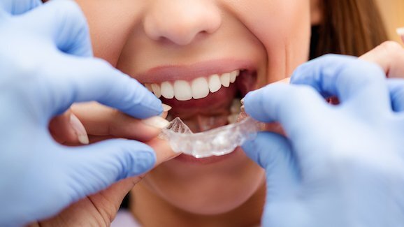Интервю: Лечението с алайнери става все по-добро