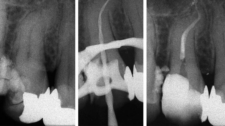 Otturazione canalare mediate la tecnica M-seal: una tecnica efficace anche nelle anatomie complesse