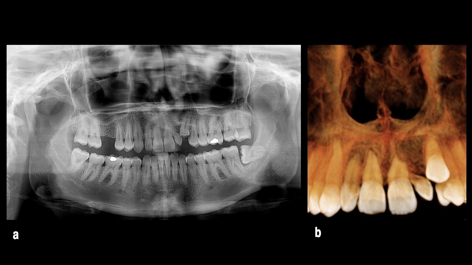 Abordaje mínimamente invasivo en ortodoncia