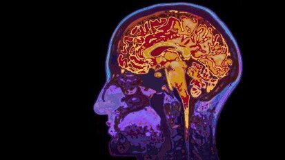 Pesquisadores encontram a relação entre bactérias orais, micro hemorragia cerebral e acidente vascular cerebral
