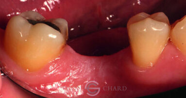 Implant restoration with CEREC Implant restoration with CEREC