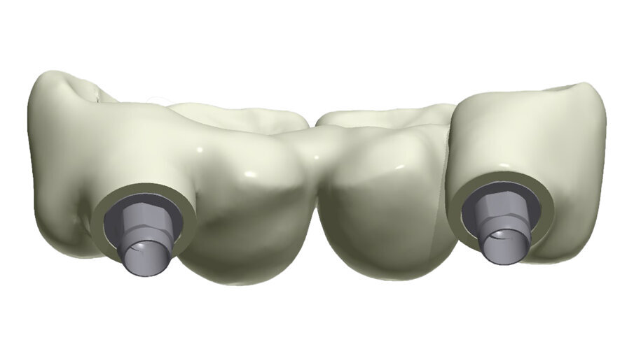 Fig. 38_Il ponte tra gli impianti in Zirconia rappresenta un progetto complesso tra il rispetto del tunnel mucoso, l’anatomia vestibolare, gli spazi circolari e il foro per l’avvitamento coronale.