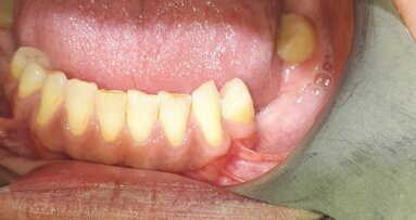 Śródkostna postać torbieli naskórkowej zlokalizowana w żuchwie – opis przypadku