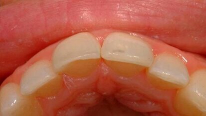 Prosta technika warstwowa do wypełnień kompozytowych wykonywanych metodą bezpośrednią