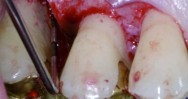 Regeneration in der Parodontaltherapie