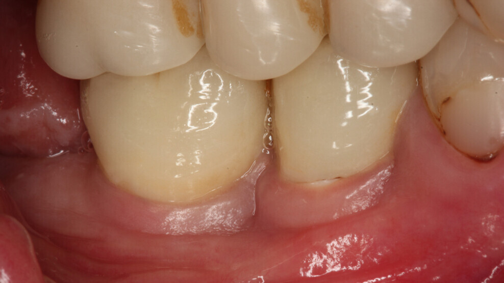 The study included patients with challenging conditions for implant treatment, such as Down’s syndrome or cancer, or those on medications like antihypertensives and immunosuppressants. (Image: Karapataki et al. 2023)