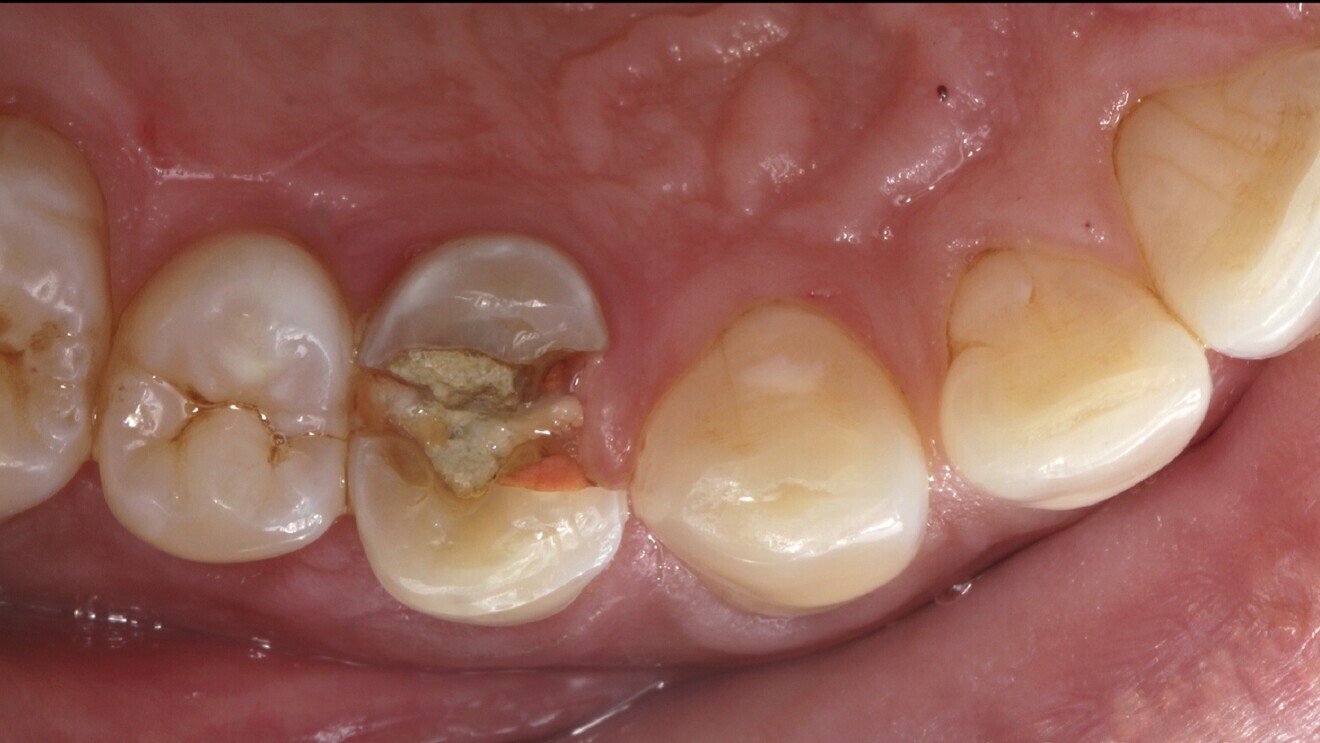 Fig. 6: Fractured tooth #14.