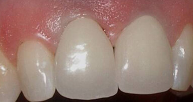 Zirconium dioxide implant solutions: A metal-free option