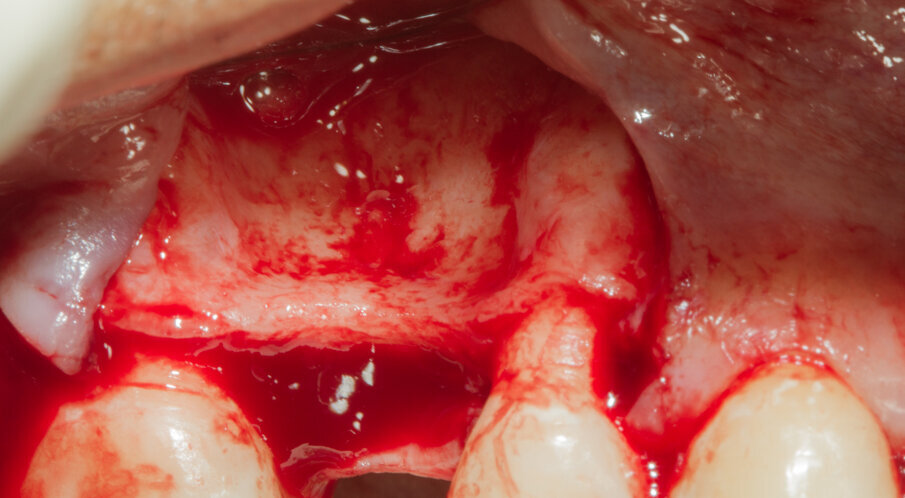 Fig. 5 - Il marcato avvallamento osseo è presente in tutta l’altezza del vestibolo.