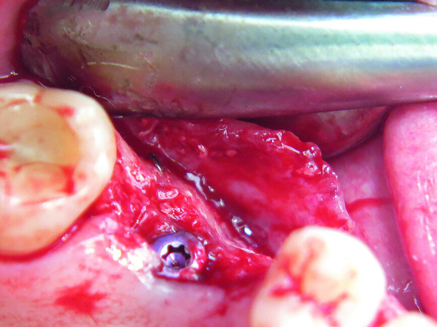 Fig. 18: New bone around implant.
