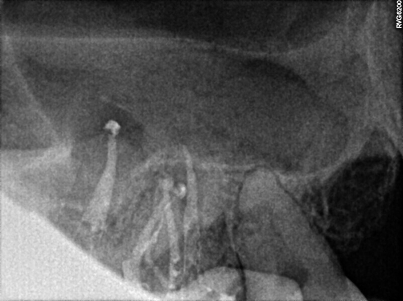 Fig. 24: Post-op radiograph, distal shift, showing that the MB2 canal of the second molar was filled with the sealer.