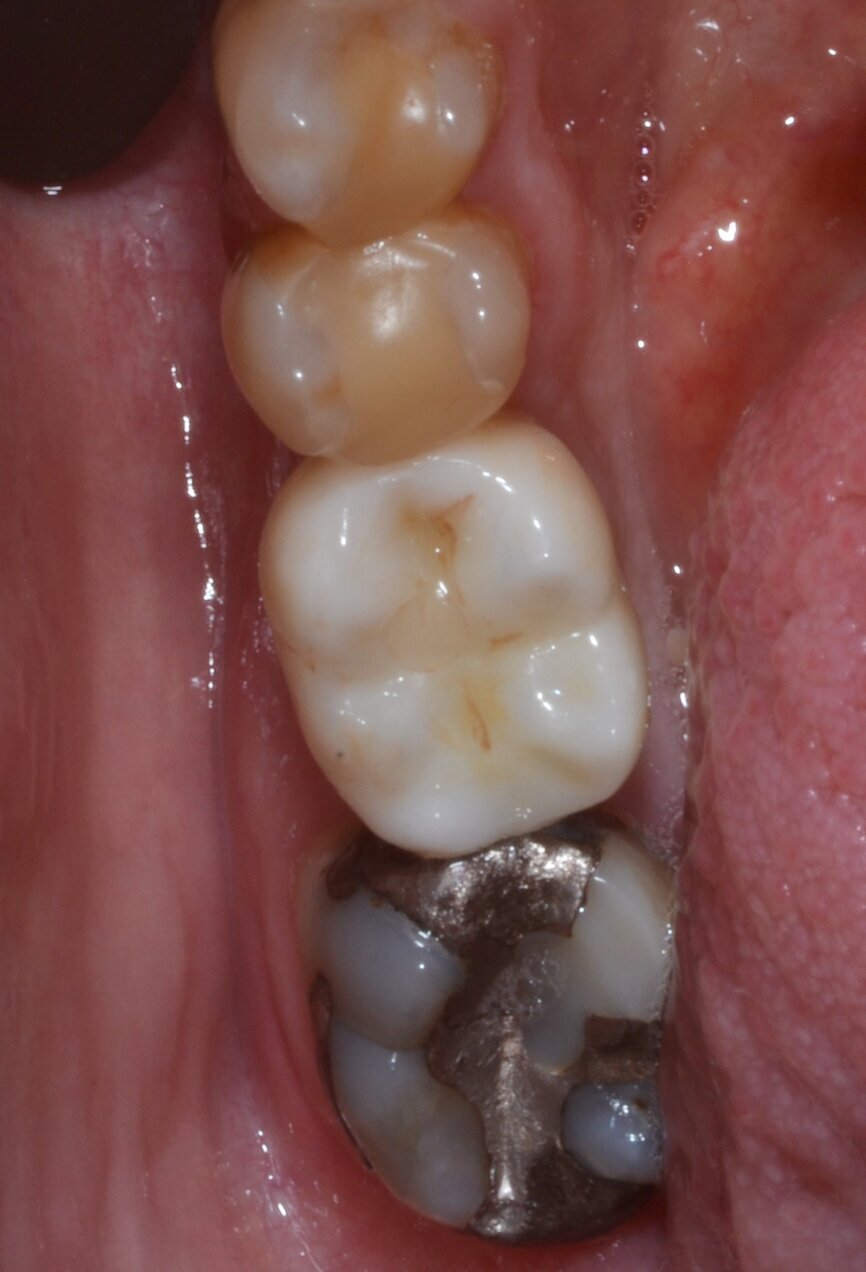 Fig. 17: Final crown in position, occlusal view.