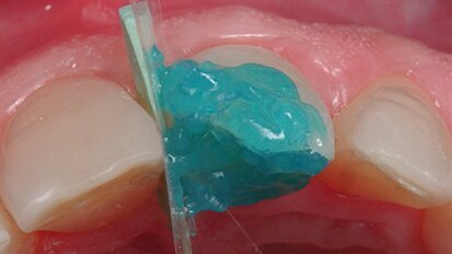 Figura 3. Grabando esmalte biselado con ácido forfórico al 37%.  Figura 3. Grabando esmalte biselado con ácido forfórico al 37%.